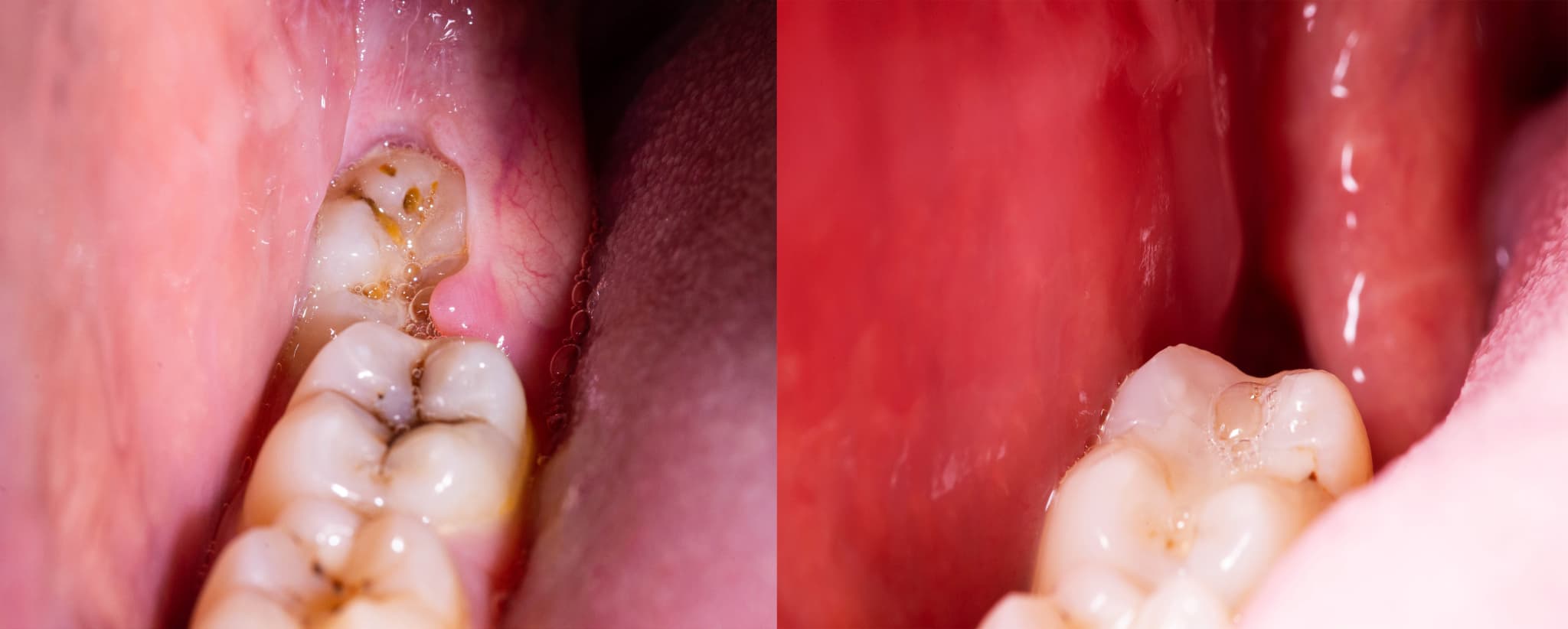 親知らずの虫歯をそのままにしてしまったイメージ