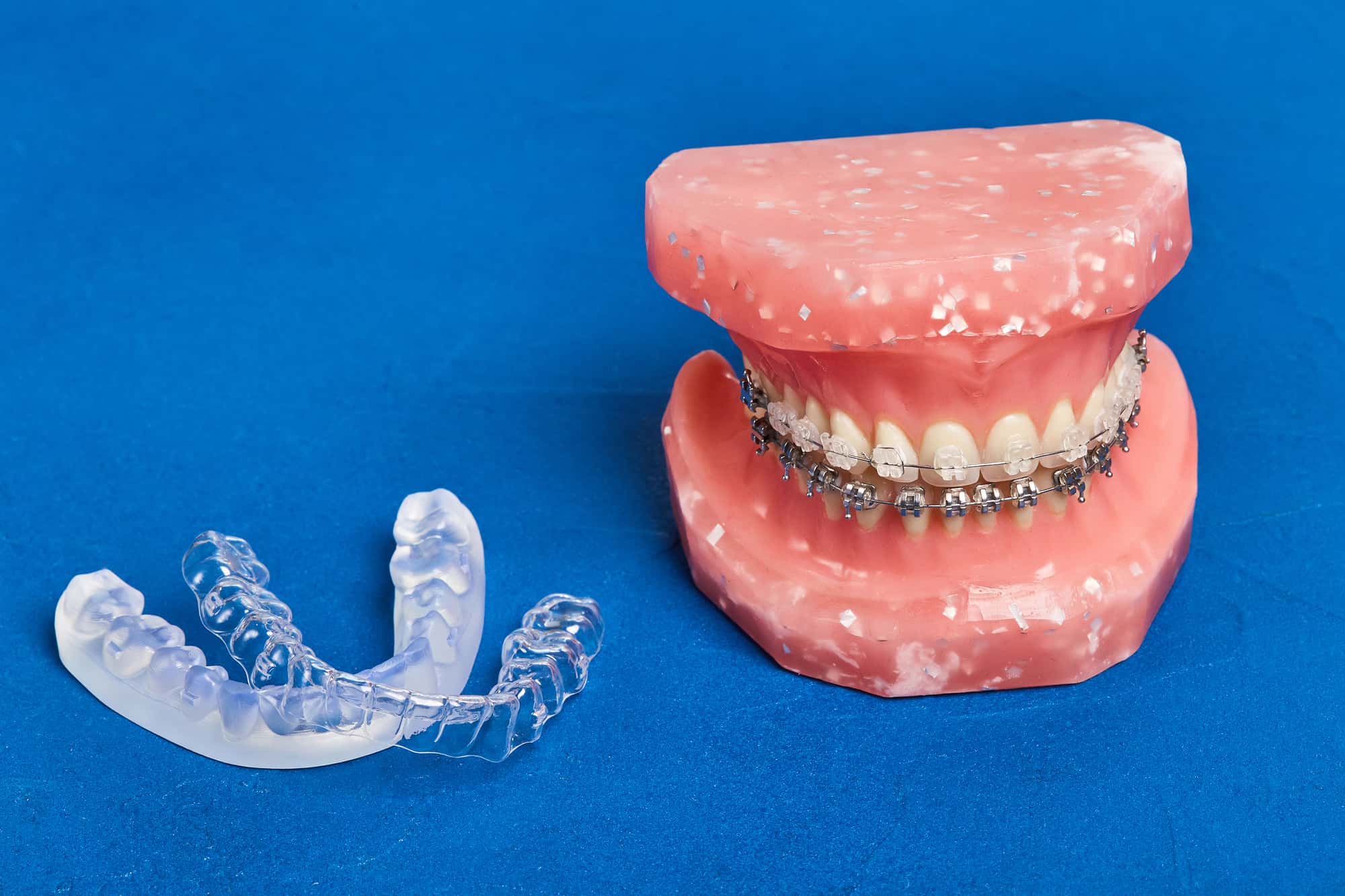 受け口を放置する方法であるワイヤー矯正とマウスピースのイメージ