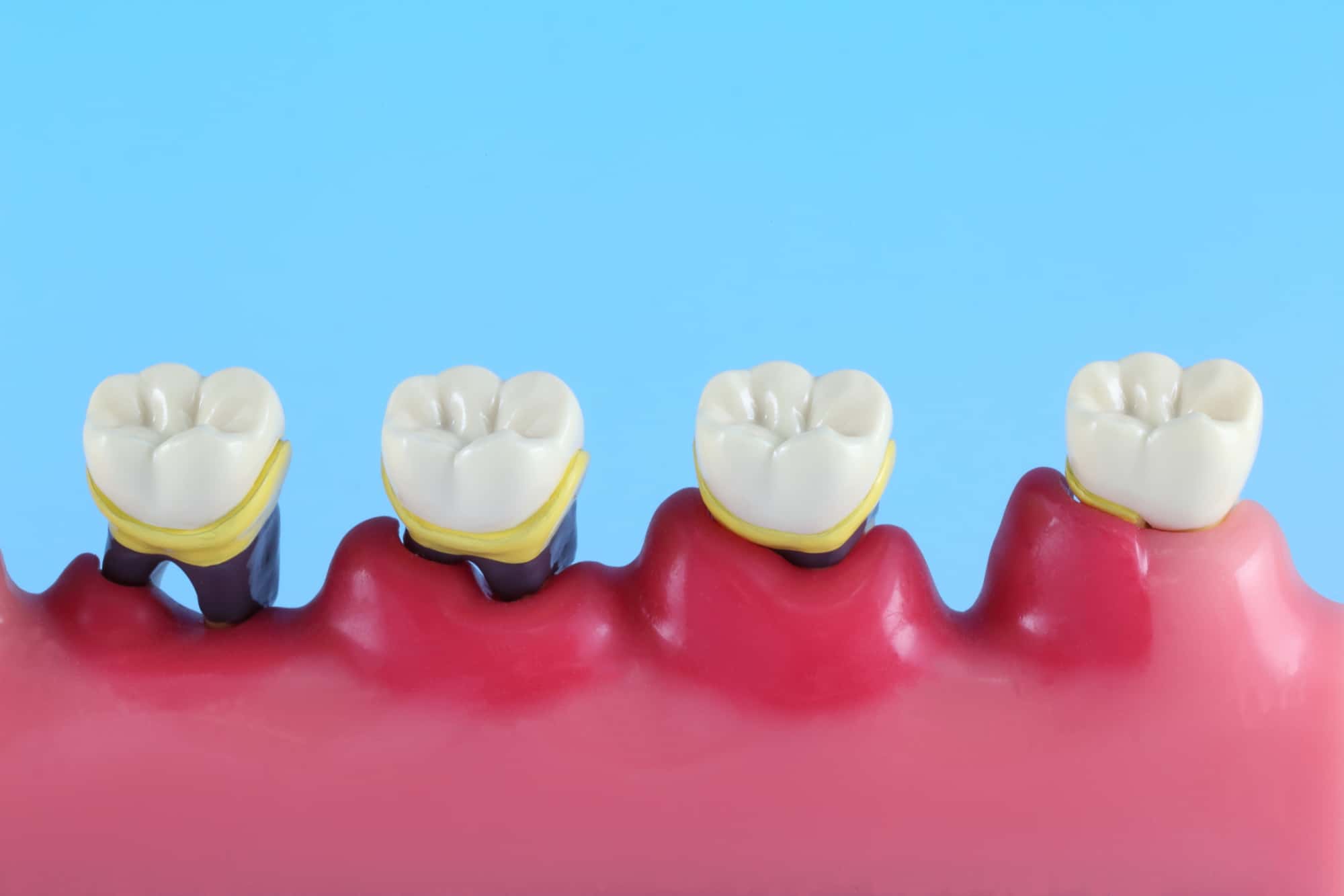 歯周病が進行する様子の模型