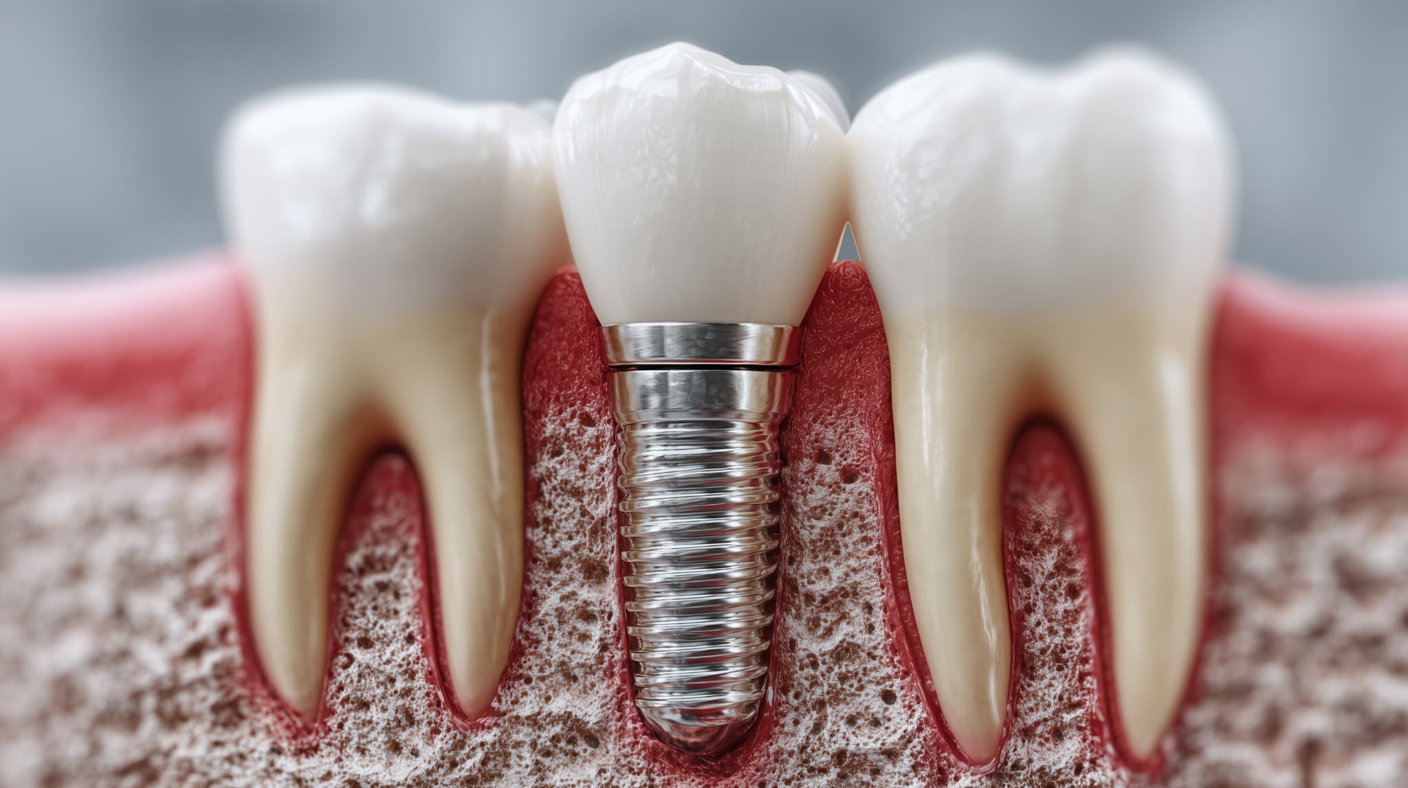 インプラントの模型