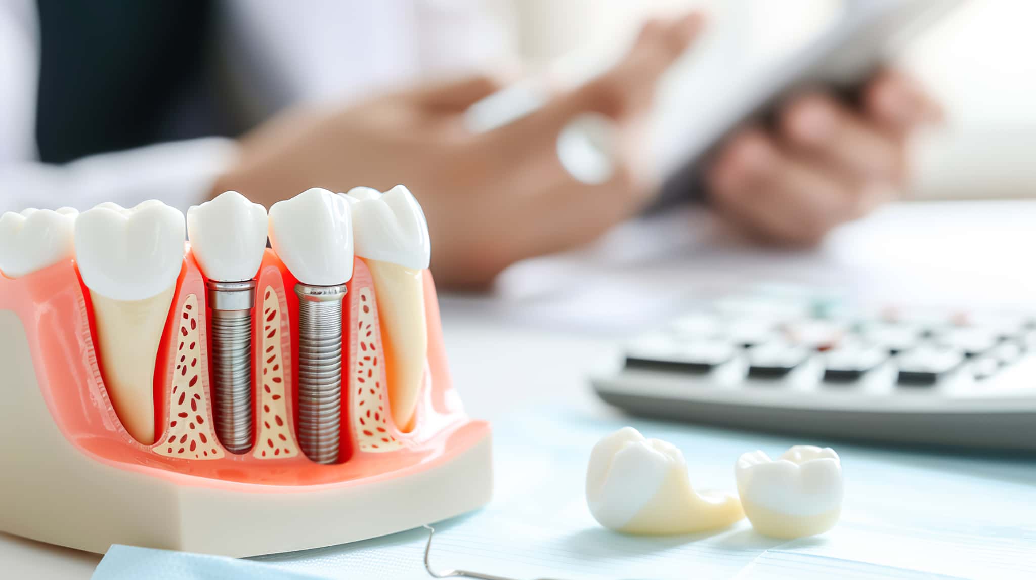 インプラント治療のやり直しにかかる費用のイメージ