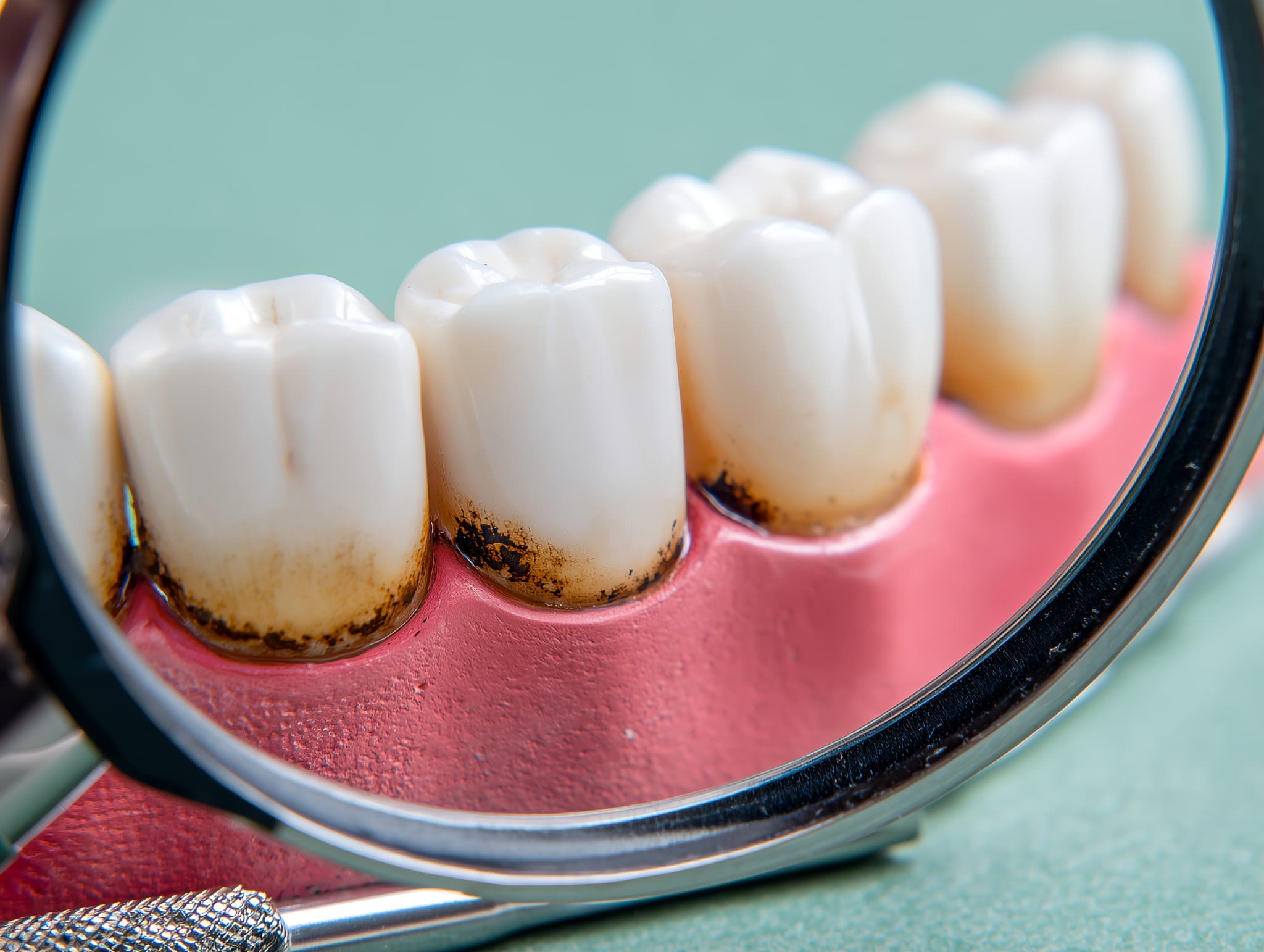 プラークが蓄積した口腔内の様子