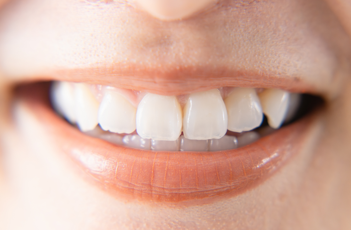 綺麗な歯並びの歯